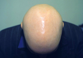 Alopecia Totalis Marbo